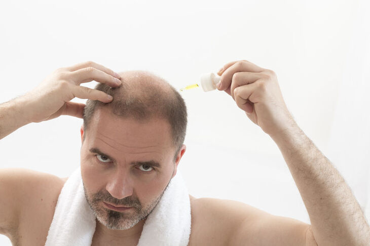 Mężczyzna testuje środek na wypadanie włosów
