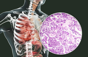 Objawy zarażenia pneumokokami u człowieka