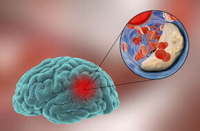 Mózg człowieka podczas udaru
