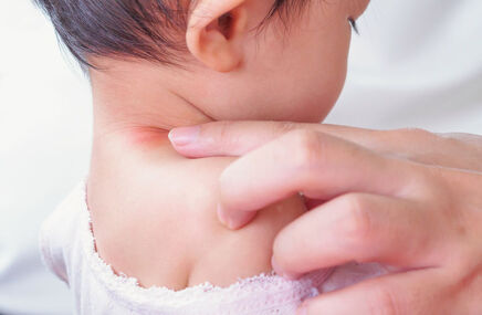 Odparzenia na szyi u dziecka