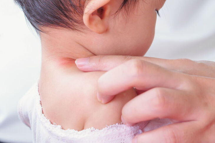 Odparzenia na szyi u dziecka