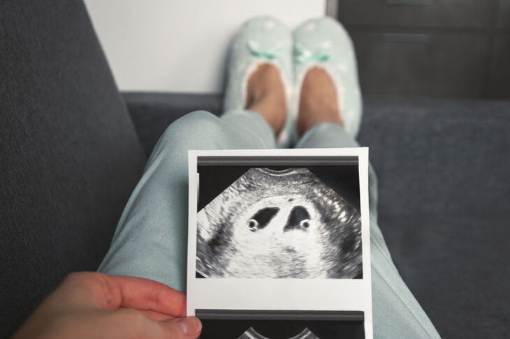 Kobieta trzyma w dłoni zdjęcie z badania USG w ciąży