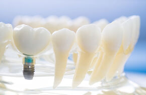 Model szczęki pokazujący implant zęba 