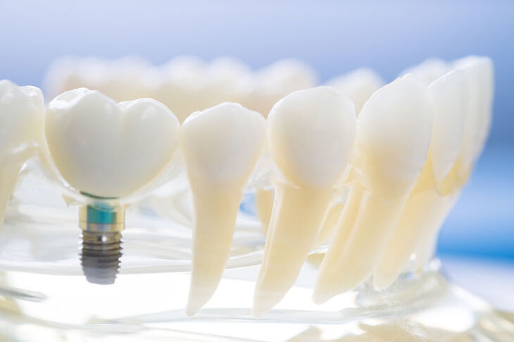 Model szczęki pokazujący implant zęba 