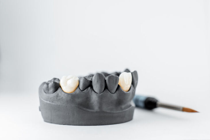 Model protetyczny z porcelanowymi koronami zębowymi
