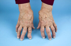 Dłoni kobiety chorującej na artretyzm