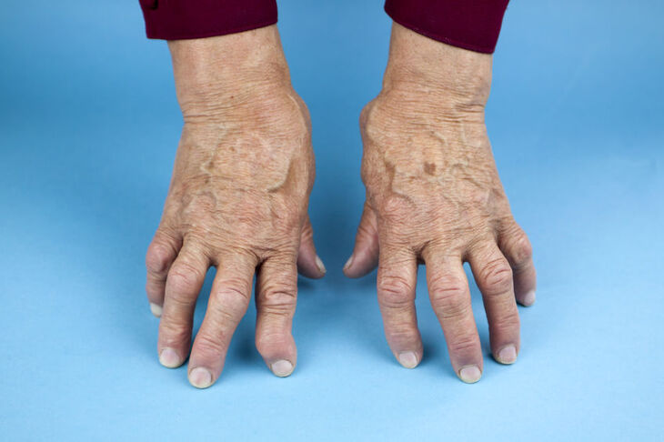 Dłoni kobiety chorującej na artretyzm