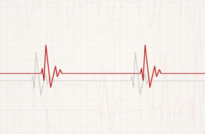 Wykres z badania EKG ukazujący bradykardię