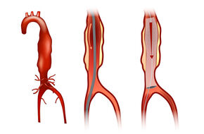 Wizualizacja tętniaka aorty brzusznej