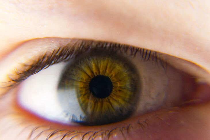 Oko z widocznymi guzkami Lischa