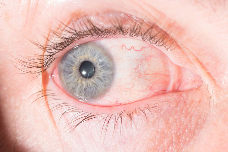 Twardówka oka objęta procesem zapalnym