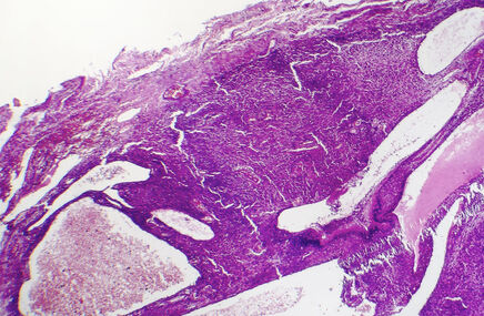 Mikroskopowy obraz włókniakomięsaka