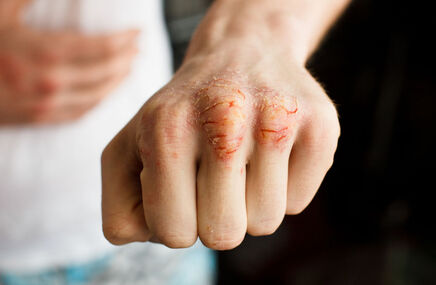Mężczyzna pokazuje pękającą skórę na palcach
