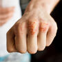Mężczyzna pokazuje pękającą skórę na palcach
