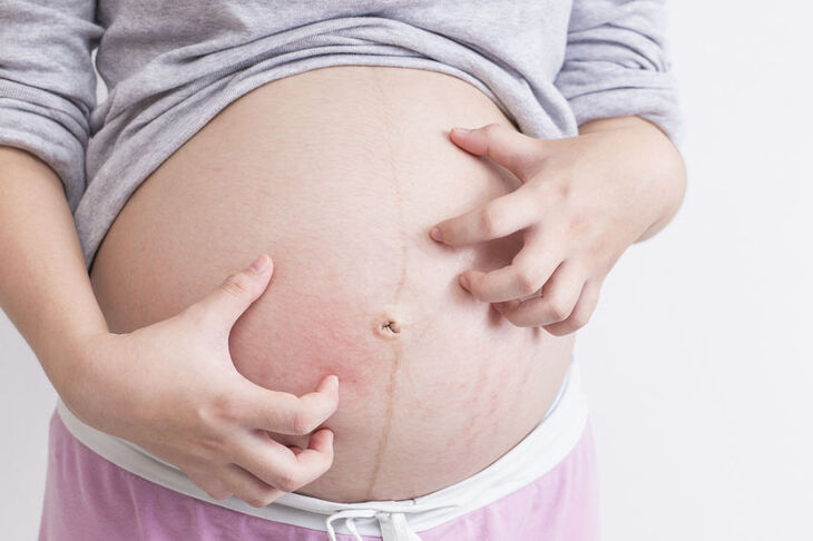 Kobieta w ciąży drapie się po brzuchu