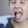 Mężczyzna z objawami grzybica jamy ustnej