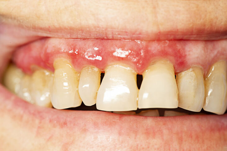 Zęby zaatakowane parodontozą