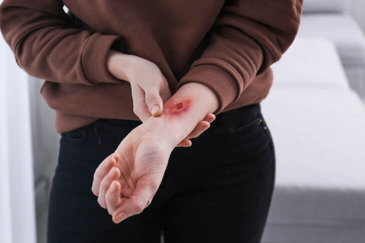 Kobieta z blizną po oparzeniu na ręce
