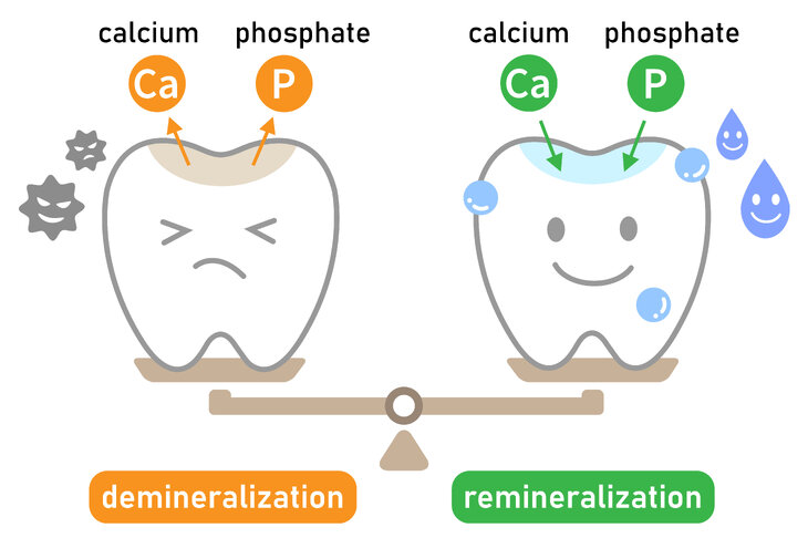 Remineralizacja szkliwa jest procesem przeciwnym do demineralizacji