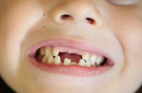 Zęby mleczne u dziecka
