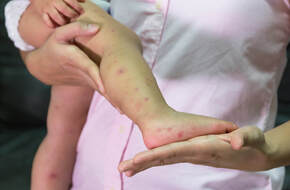 Drobne czerwone krostki na nogach dziecka