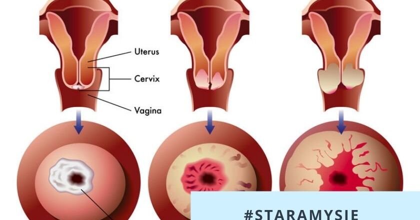endometrium rák 2. stádium a hpv más rákot okoz-e