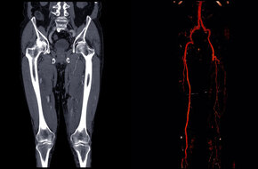 Zdjęcie rentgenowskie po arteriografii