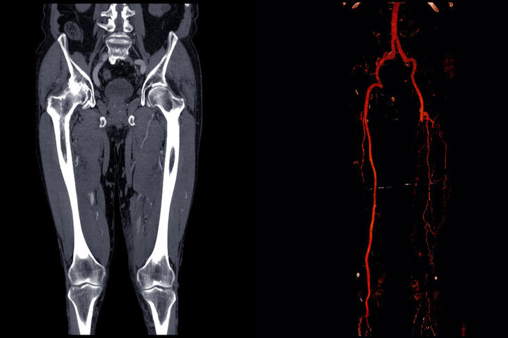 Zdjęcie rentgenowskie po arteriografii