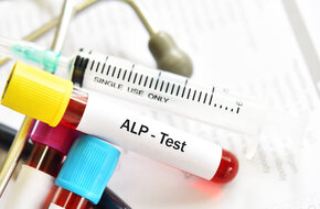 Próba z krwią do badania poziomu fosfatazy alkalicznej