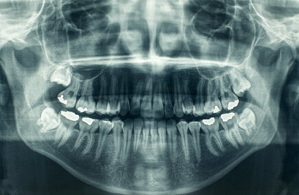 Zdjęcie pantomograficzne zębów