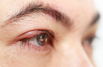 Ludzkie oko z objawem zapalenie nerwu wzrokowego