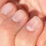 Suche skórki wokół paznokci
