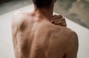 Mężczyzna z oparzeniami skóry na plecach