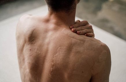Mężczyzna z oparzeniami skóry na plecach
