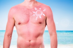 Mężczyzna ze schodzącą skórą po opalaniu stoi na plaży