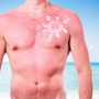 Mężczyzna ze schodzącą skórą po opalaniu stoi na plaży