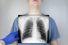 Rentgen płuc po zachłystowym zapaleniu płuc