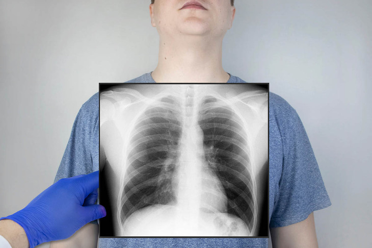 Rentgen płuc po zachłystowym zapaleniu płuc