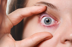 Pacjenta z alergicznym zapaleniem spojówek oczu