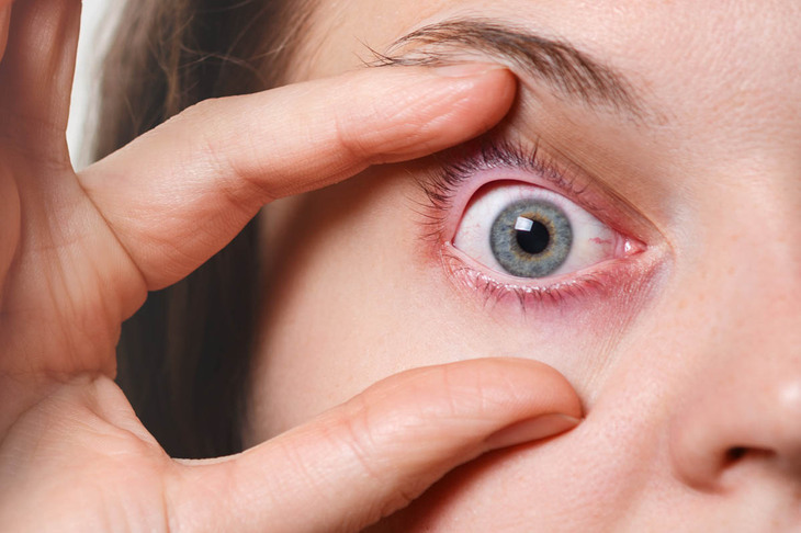 Pacjenta z alergicznym zapaleniem spojówek oczu