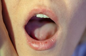 Objawy leukoplakii w jamie ustnej