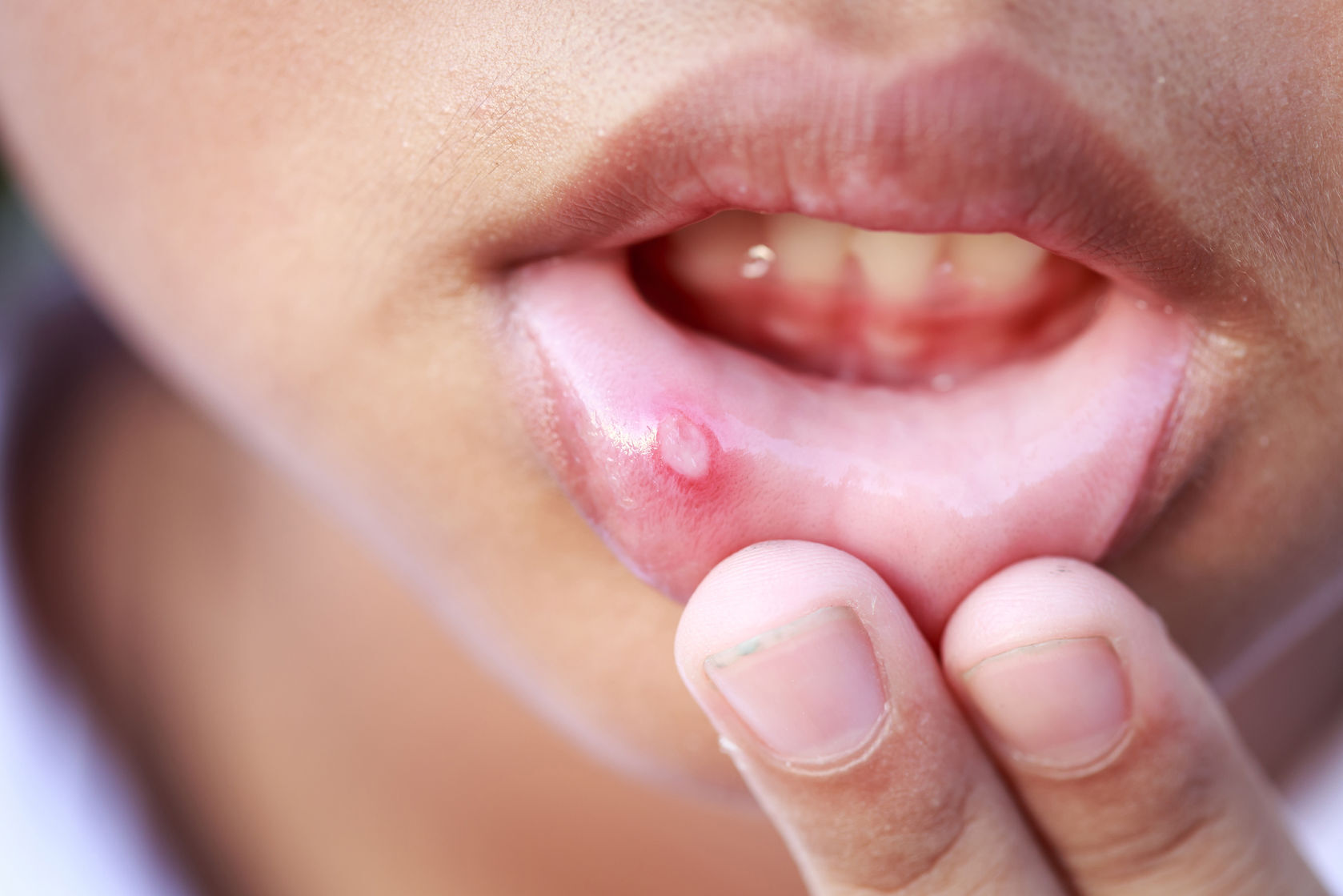 Opryszczkowe Zapalenie Jamy Ustnej U Dzieci Zdjęcia
