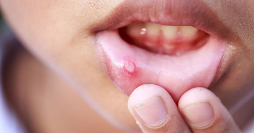 Opryszczkowe Zapalenie Jamy Ustnej Atakuje Dzieci