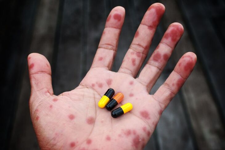 Tabletki na dłoni, która jest w czerwonych krostach