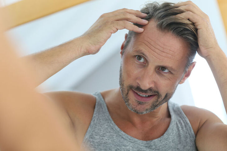 Mężczyzna cierpiący na łysienie androgenowe