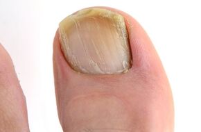 Duży paznokcieć u stóp z żółtą grzybicą