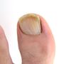 Duży paznokcieć u stóp z żółtą grzybicą