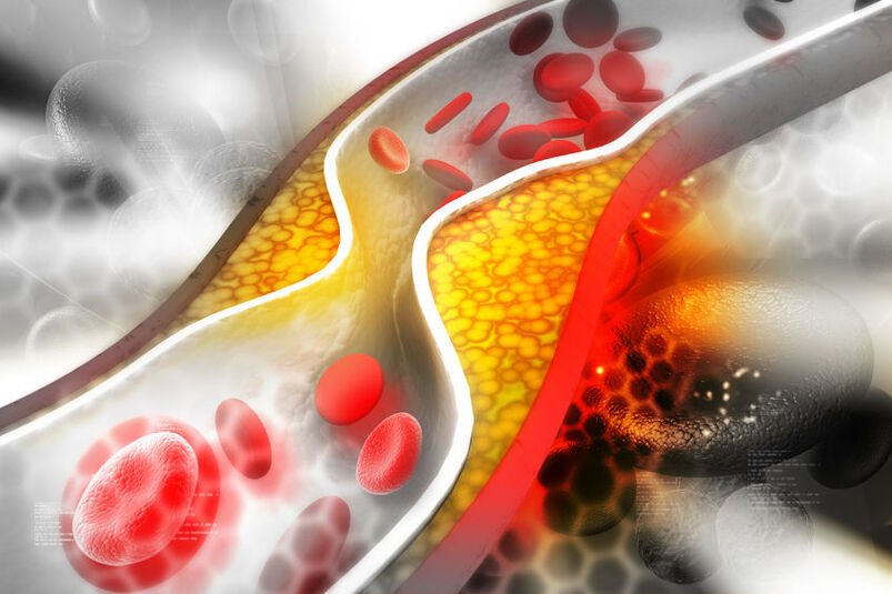 Podwyższony poziom cholesterolu w układzie krwionośnym