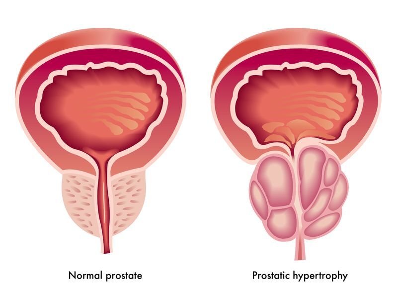 problemy z gruczołem prostaty wpływają na erekcję śpi mały penis