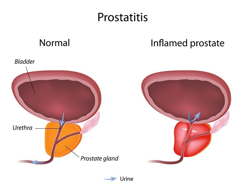z zapaleniem prostaty, mogą występować problemy z erekcją podziwia penisa